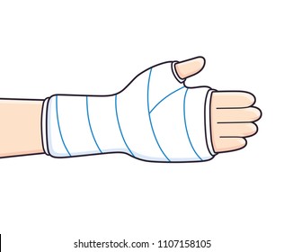 Broken arm, bone fracture, orthopedic plaster cast vector isolated.