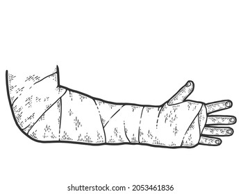 gebrochener Arm, Knochenbrüche, Trauma, orthopädischer Gips gewirkt. Sketch-Kratzer-Imitation.