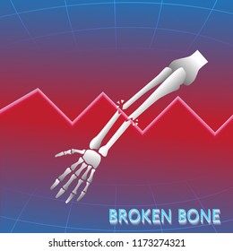 Broken arm bone lateral view show fracture of ulna and radius bone