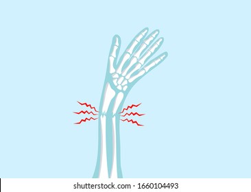 Broken arm bone vertor illustration in x-ray style for Emergency accident injury concept.