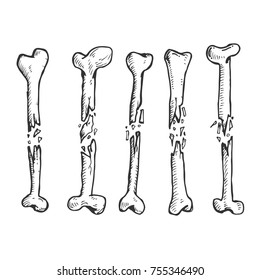 Broken bones in hand drawn vintage style. Sketch vector illustration isolated on white background.