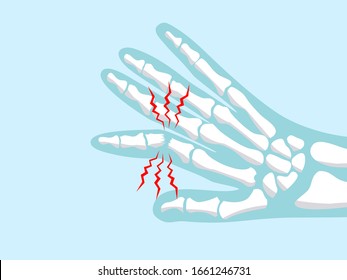 Broken Finger Bone Vertor Illustration In X-ray Style For Emergency Accident Injury Concept.