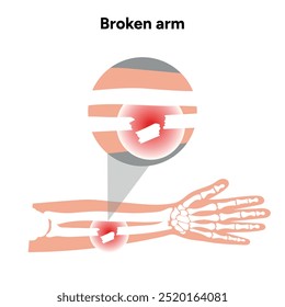 Lesiones fracturadas en el brazo, Traumatismo significativo