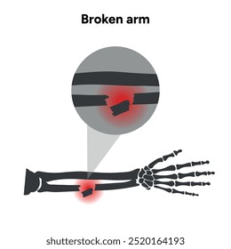 Braço com lesões quebradas, trauma significativo, zoom de raios-X