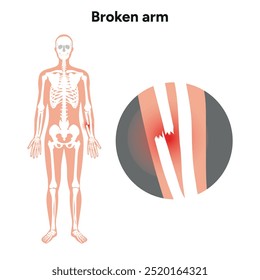 Broken injuries arm, Significant trauma zoom