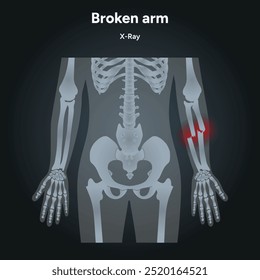 Lesiones fracturadas en el brazo, Traumatismo significativo, rayos X