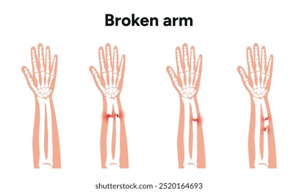 Lesiones fracturadas en el brazo, Traumatismo significativo, caídas 