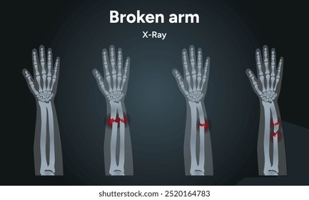 Braço com lesões quebradas, trauma significativo, raios-X de quedas