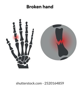 Broken injuries arm, Significant trauma, falls x-ray