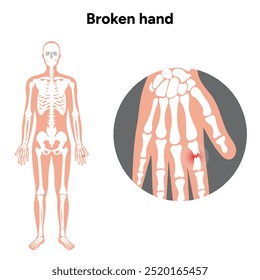 Gebrochene Verletzungen Arm, Signifikante Trauma, Stürze Zoom