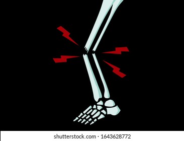 Ilustración del vertor de hueso y hueso del pie en forma de rayos X para el concepto de accidente de emergencia.