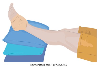 broken leg illustration vector image