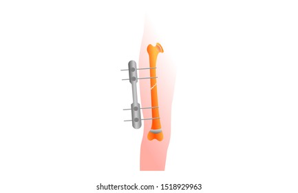 Broken thigh bone. External fixation. Fracture of the thigh bone and splint