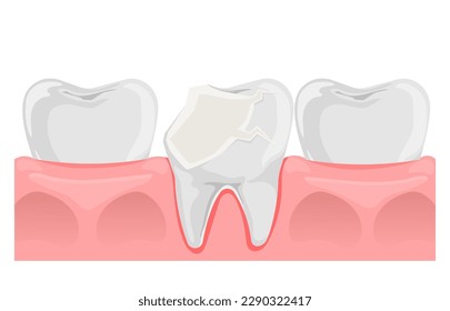 Diente roto. Diente roto en estilo plano. Anatomía de dientes y encías. Salud dental. Ilustración vectorial aislada en fondo blanco.