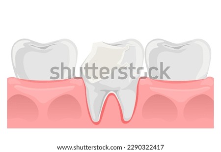 Broken Tooth. Cracked tooth in flat style. Teeth and gum anatomy. Dental health. Vector illustration isolated on white background.