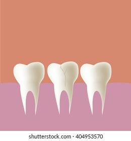 broken tooth in mouth, Vector illustration.