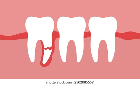 broken wisdom tooth root, flat color illustration