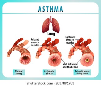 Bronchial Asthma diagram with normal airway and asthmatic airway illustration