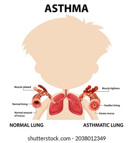 Bronchial Asthma diagram with normal lung and asthmatic lung illustration