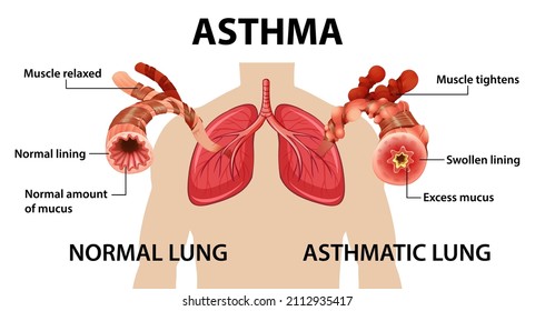 967 Asthma Diagram Images, Stock Photos & Vectors | Shutterstock