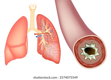 Bronchiectasis and  Increased secretion Mucus. Human bronchus in cross section with mucus. Bacterial Infection in the Lungs