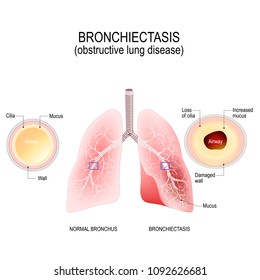 Bronchiectasis. Normal Bronchus And Bronchiectasis. Enlarged Small Airways That Collect Mucus And Cause Recurrent Lung Infections. Obstructive Lung Disease