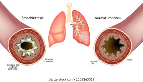 Bronquiectasia e Bronco Normal. Aumento da secreção Muco. Parede destruída e Cília danificada Bronchus