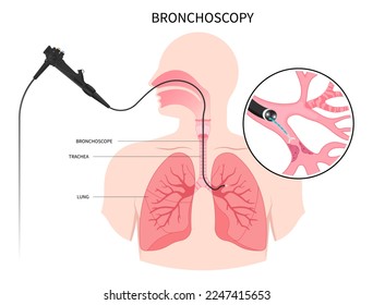 Bronchioles tumor cancer malignant cell surgical with flexible fiber optic guided medical chest X RAY test lymph node masses chronic asthma mucus plug bronchi washing