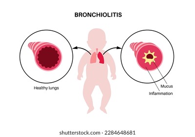 Infección por bronquiolitis en el cuerpo de los niños pequeños. Infección viral de pulmones en la silueta infantil. Inflamación y moco en las vías respiratorias. Enfermedad pulmonar, dolor en el tórax y tos, ilustración vectorial plana.