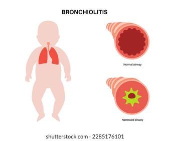 Infección por bronquiolitis en el cuerpo de los niños pequeños. Infección viral de pulmones en la silueta infantil. Inflamación y moco en las vías respiratorias. Enfermedad pulmonar, dolor en el tórax y tos, ilustración vectorial plana.