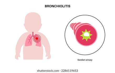 Infección por bronquiolitis en el cuerpo de los niños pequeños. Infección viral de pulmones en la silueta infantil. Inflamación y moco en las vías respiratorias. Enfermedad pulmonar, dolor en el tórax y tos, ilustración vectorial plana.