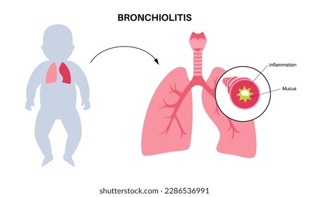 Bronchiolitis infection in young child body. Viral infection of lungs in the infant silhouette. Inflammation and mucus in the airways. Lung disease, pain in chest and cough flat vector illustration.