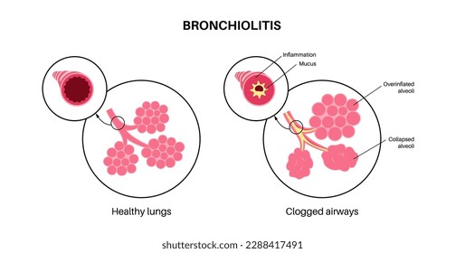 Bronchiolitis infection in young child body. Viral infection of lungs. Newborn internal organ. Inflammation, swelling and mucus in the airways. Lung disease, pain in chest flat vector illustration.