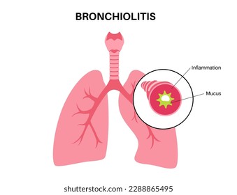 Bronchiolitis infection in young child body. Viral infection of lungs. Newborn internal organ. Inflammation, swelling and mucus in the airways. Lung disease, pain in chest flat vector illustration.