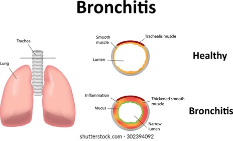 Bronchitis Images Stock Photos Vectors Shutterstock - 