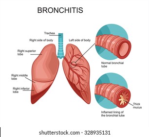 Bronchitis