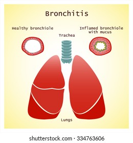 Bronchitis.