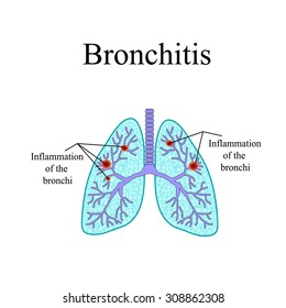 Bronchitis. The anatomical structure of the human lung. Vector illustration on isolated background.