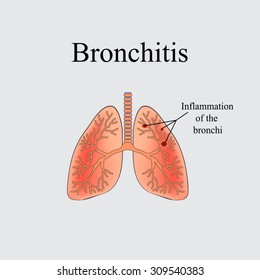 Bronchitis. The anatomical structure of the human lung. Vector illustration on a gray background.