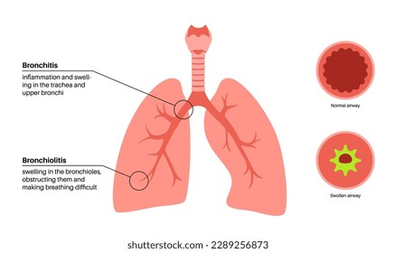 Bronchitis und Bronchiolitis, Lungeninfektion. Bronchi anatomisches Poster. Reizende, Schwellungen und entzündete Atemwege. Atembeschwerden, Husten, Brustschmerzen und Schleim in der Lunge Vektorgrafik