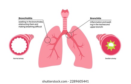 Bronchitis and bronchiolitis, infection of the lungs. Bronchi anatomical poster. Irritated, swelling and inflamed airways. Difficult breathing, cough, chest pain and mucus in lungs vector illustration