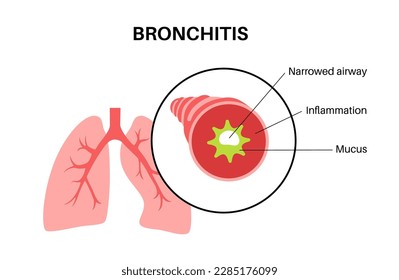 Concepto de bronquitis, infección de los pulmones. Afiche anatómico de Bronchi. Vías aéreas irritadas, hinchadas e inflamadas. Difícil respiración, tos, dolor torácico y moco en pulmones de ilustración vectorial plana.