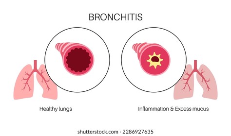 Bronchitis concept, infection of the lungs. Bronchi anatomical poster. Irritated, swelling and inflamed airways. Difficult breathing, cough, chest pain and mucus in lungs flat vector illustration.