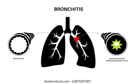 Bronchitis concept, infection of the lungs. Bronchi anatomical poster. Irritated, swelling and inflamed airways. Difficult breathing, cough, chest pain and mucus in lungs flat vector illustration.
