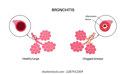 Bronchitis concept, infection of the lungs. Bronchi anatomical poster. Irritated, swelling and inflamed airways. Difficult breathing, cough, chest pain and mucus in lungs flat vector illustration.