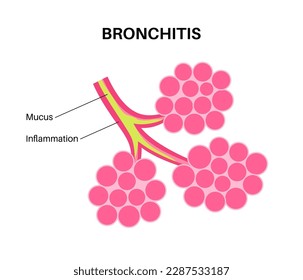 Bronchitis-Konzept, Lungeninfektion. Bronchi anatomisches Poster. Reizende, Schwellungen und entzündete Atemwege. Atembeschwerden, Husten, Brustschmerzen und Schleim in der Lunge flache Vektorgrafik.