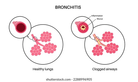 Bronchitis concept, infection of the lungs. Bronchi anatomical poster. Irritated, swelling and inflamed airways. Difficult breathing, cough, chest pain and mucus in lungs flat vector illustration.