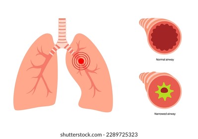 Bronchitis concept, infection of the lungs. Bronchi anatomical poster. Irritated, swelling and inflamed airways. Difficult breathing, cough, chest pain and mucus in lungs flat vector illustration.