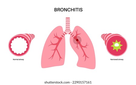 Bronchitis concept, infection of the lungs. Bronchi anatomical poster. Irritated, swelling and inflamed airways. Difficult breathing, cough, chest pain and mucus in lungs flat vector illustration.