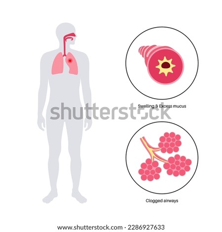 Bronchitis concept, infection of the lungs. Bronchi anatomical poster. Irritated, swelling and inflamed airways. Difficult breathing, cough, chest pain and mucus in lungs flat vector illustration.